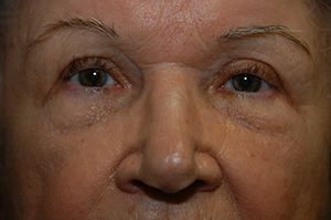 Blepharoplasty 1b